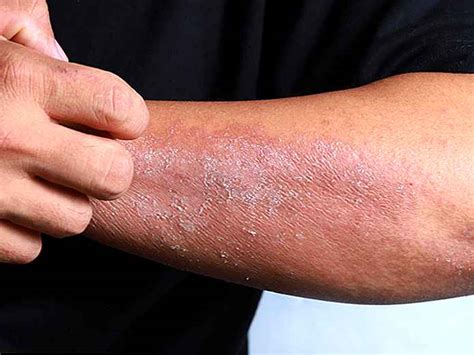 Dermatitis De Contacto Tipos Causas Y S Ntomas Es Odysseedubienetre Be