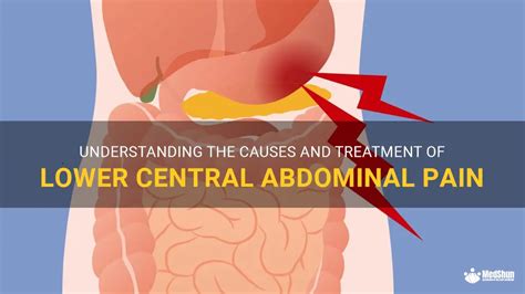 Understanding The Causes And Treatment Of Lower Central Abdominal Pain MedShun