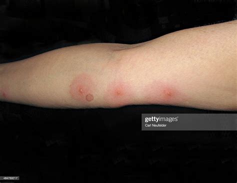 Bed Bug Bite Blisters High Res Stock Photo Getty Images