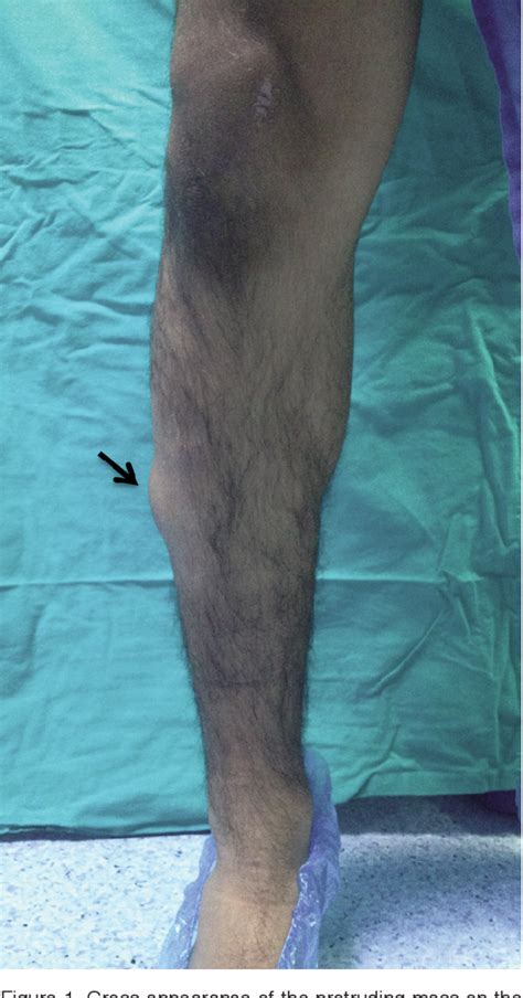 Figure 2 From Double Layer Repair Of Tibialis Anterior Muscle Hernia In