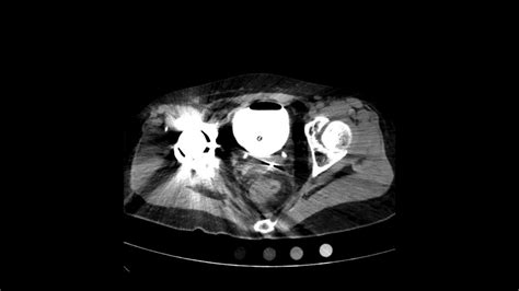 Bladder Rupture Ct Cysto Axial Jetem Youtube