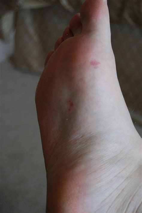 I Have 4 Small Red Spots On The Arch Of My Right Foot I Noticed