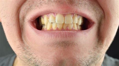 Gigi Kuning Bukan Berarti Menunjukkan Tanda Kesehatan Mulut Yang Buruk