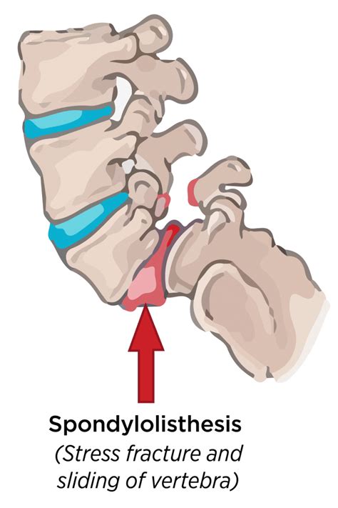 Spondylolisthesis Grading How To Diagnose And Treat Grades 1 2 3 4 And