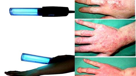 Ultraviolet Light Therapy