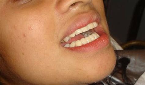 Cosmetic Correction For Protruding Teeth In Few Hours India Dental