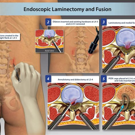 Endoscopic Laminectomy And Fusion Trialexhibits Inc