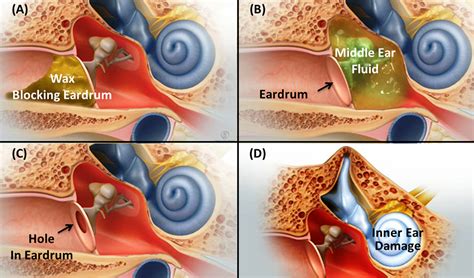 Conductive Hearing Loss Causes Symptoms And Best Treatment