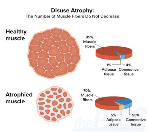 How To Fight Muscle Atrophy After Injury A Personal Trainers Guide