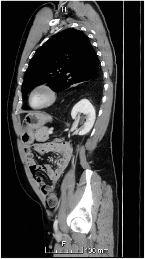 A Sagittal View Of A Left Sided Bochdalek Hernia From A Ct Scan