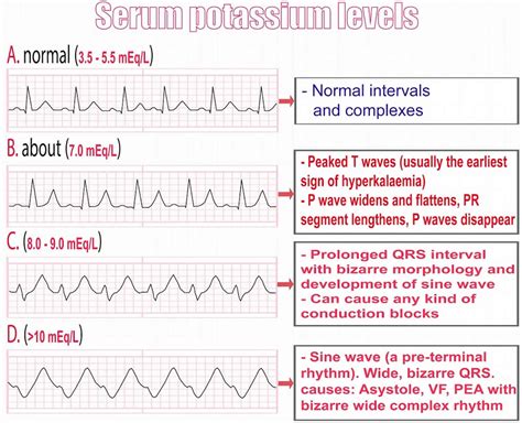 Hyperkalemia Causes Signs Symptoms Ecg Changes And