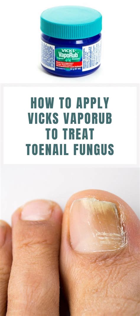 How To Apply Vicks Vaporub To Treat Toenail Fungus Vicks Vaporub