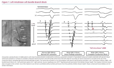 Left Intrahisian Left Bundle Branch Block Radcliffe Cardiology