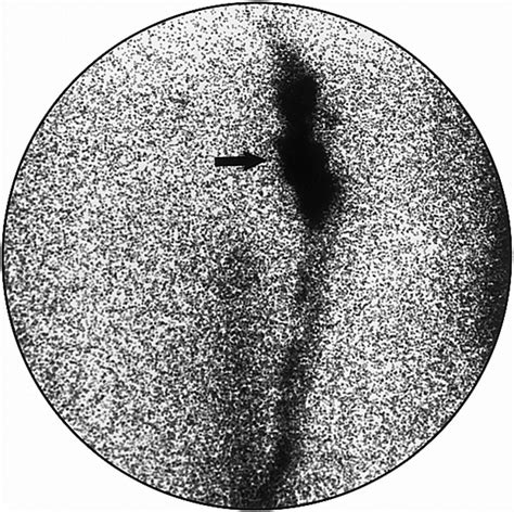 Lymphoscintigraphy In Cutaneous Melanoma A Total Body Atlas Of