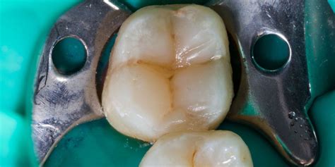 If you feel a hole, it's probably a cavity. What Does A Cavity Look Like? How To Tell If You Have A Cavity