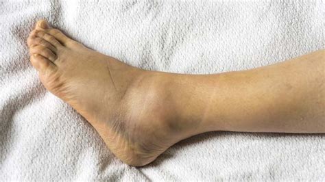 How To Heal A Grade 3 Ankle Sprain Fully And Fast