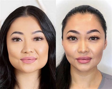 Botox I Masseter Gjør Ansiktet Smalere🥰 Botoxcapilar Beautytips