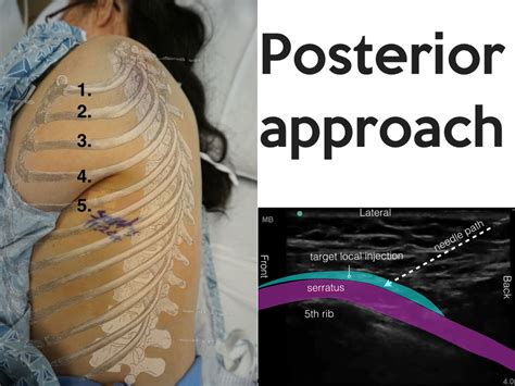Image off under ribs front and back human : PECS/SERRATUS — Highland EM Ultrasound Fueled pain management