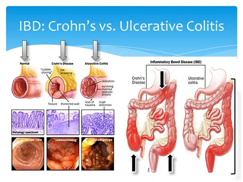 Crohns Disease Vs Ulcerative Colitis IBD Faculty Of Medicine