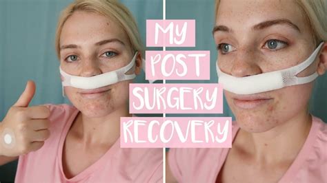 A Nose Adventure Septoplasty Day 1 The Surgery