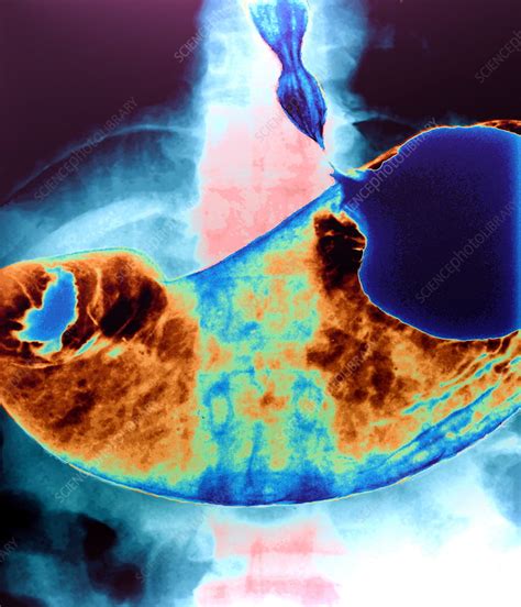 Stomach X Ray Stock Image P5100118 Science Photo Library