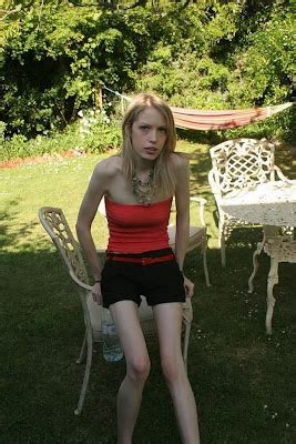 Most Amazing Photos From The World Cultures Horrors Of Anorexia