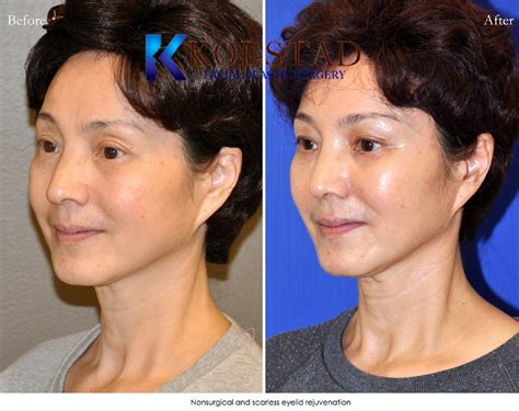 Asian Facelift Before And After Gallery Dr Kolstad San Diego Facial Plastic Surgeon
