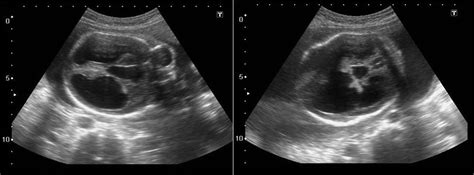 Prenatal Ultrasound Diagnosis Of Holoprosencephaly And Associated