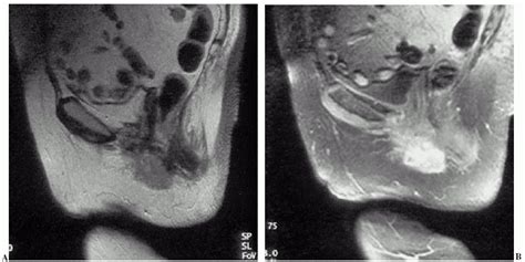 Adenocarcinoma Adenocarcinoma Vulva