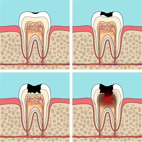 Dental Caries Progression