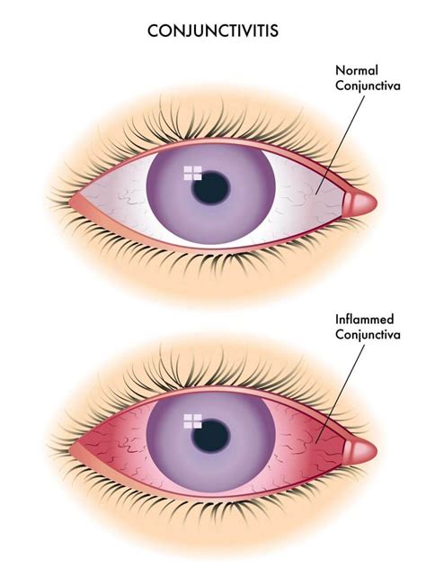 What Is Conjunctivitis Learn More About The Cause And Treatment