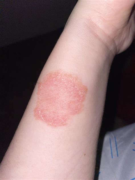 Is This Ringworm It Has Been There For A Few Weeks And It Doesnt Itch