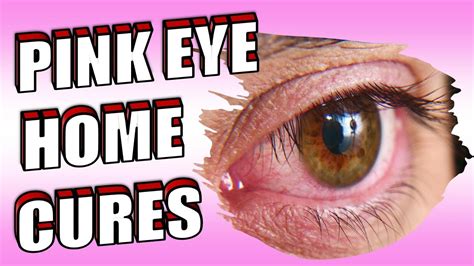 16 Powerful Pink Eye Home Remedies And Treatments How To Get Rid Of