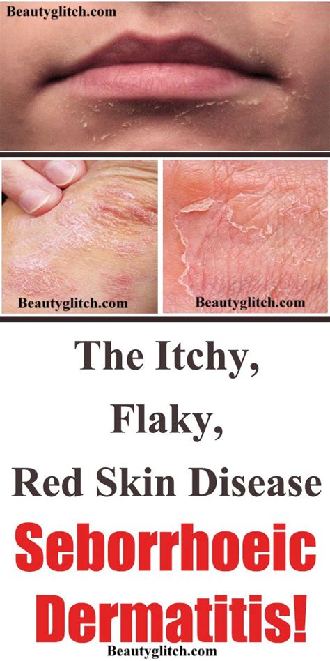 The Itchy Flaky Red Skin Disease Seborrhoeic Dermatitis Dry