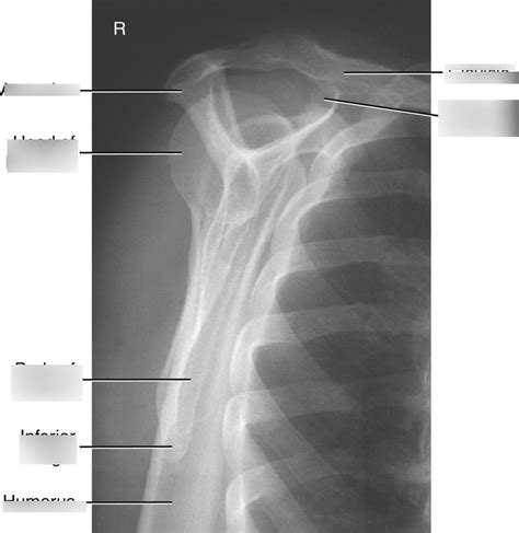 PA Oblique Projection Scapular Y Lateral Shoulder Trauma Diagram