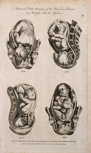 Foetuses In Utero Four Figures Showing Cross Sections Of A Free
