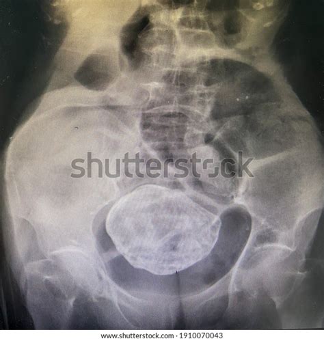 Stone Abdomen Calcified Uterine Leiomyoma Calcification Foto Stok