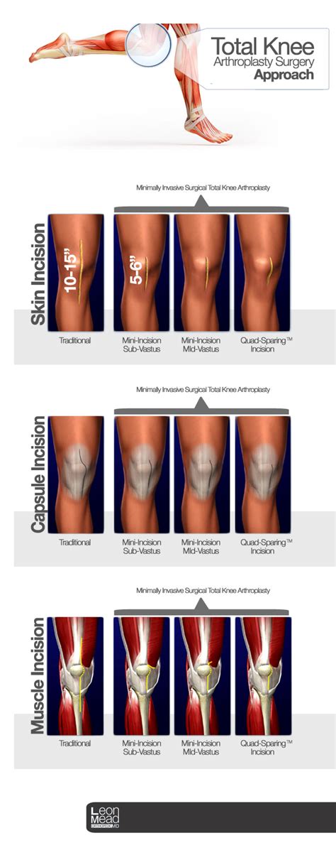 Total Knee Arthroplasty Surgery Approach Naples Orthopedic Doctor