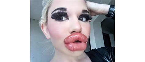 After Filler Injections Real Life Barbie Shows Off Giant Lips