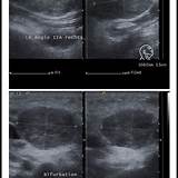 Lymph Nodes On Both Sides Of Neck Images