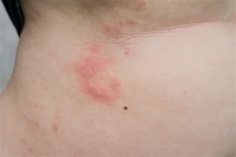 A Woman Is Urticaria On Back — Stock Photo © Wasansos1 83455910