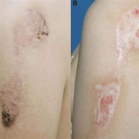 Total Patient Reported Scores Of Keloids On Different Body Parts Before