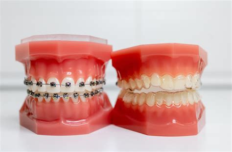 Benefits Of Teeth Alignment Options Braces Invisalign