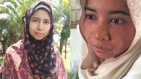 Bergelut Dengan Penyakit Kulit Yang Teruk Wanita Malaysia Ini Kuatkan