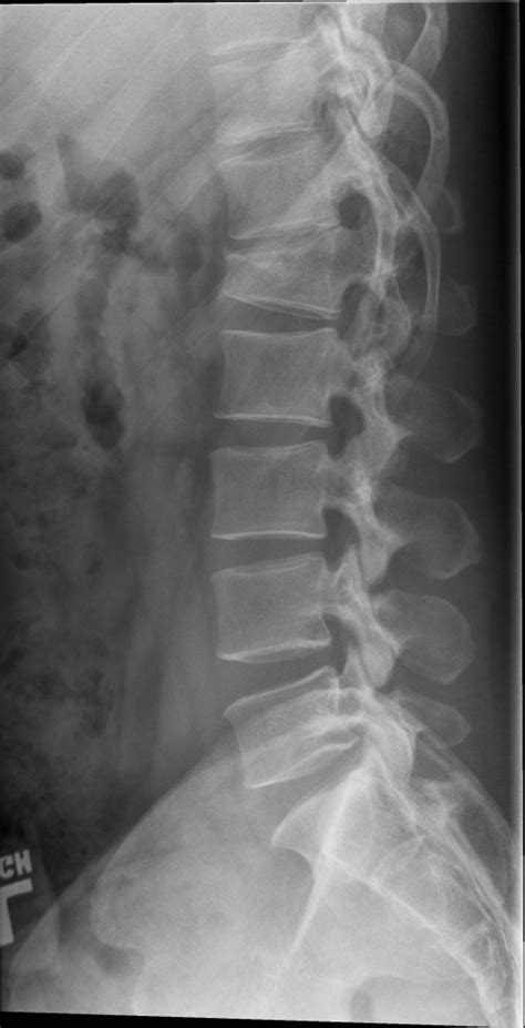 Lumbar Spine Compression Fracture Radiologypicscom