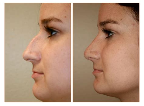 How Much Does A Male Nose Job Cost Plastic Surgery Nose Cost