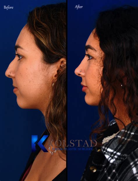 Hispanic Rhinoplasty Before And After Gallery 21 Dr Kolstad San
