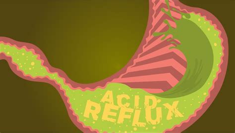 Check spelling or type a new query. Your Burning Chest: How to Stop Acid Reflux and GERD | UNC ...