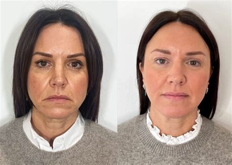 A Guide To Treating Your Wrinkles With Ha Dermal Filler The Cosmetic Skin Clinic
