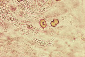 Pemeriksaan Mikroskopik Sedimen Urin Update ATLM